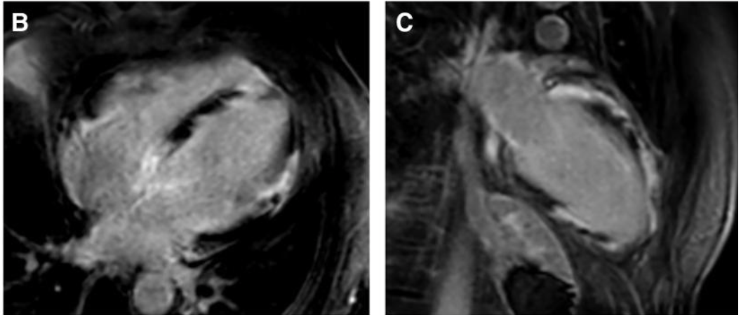 Phenotypes Of Cardiac Sarcoidosis