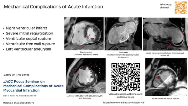 Snippet: Mechanical Complications of Acute Infarction