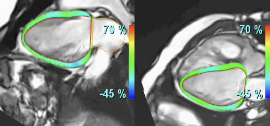 CMR in valvular HD