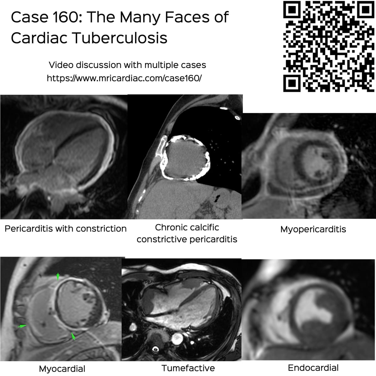 Case 160: The Many Faces of Cardiac Tuberculosis