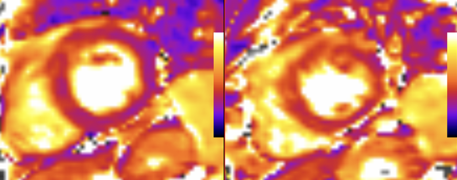 CMR in NSTEMI