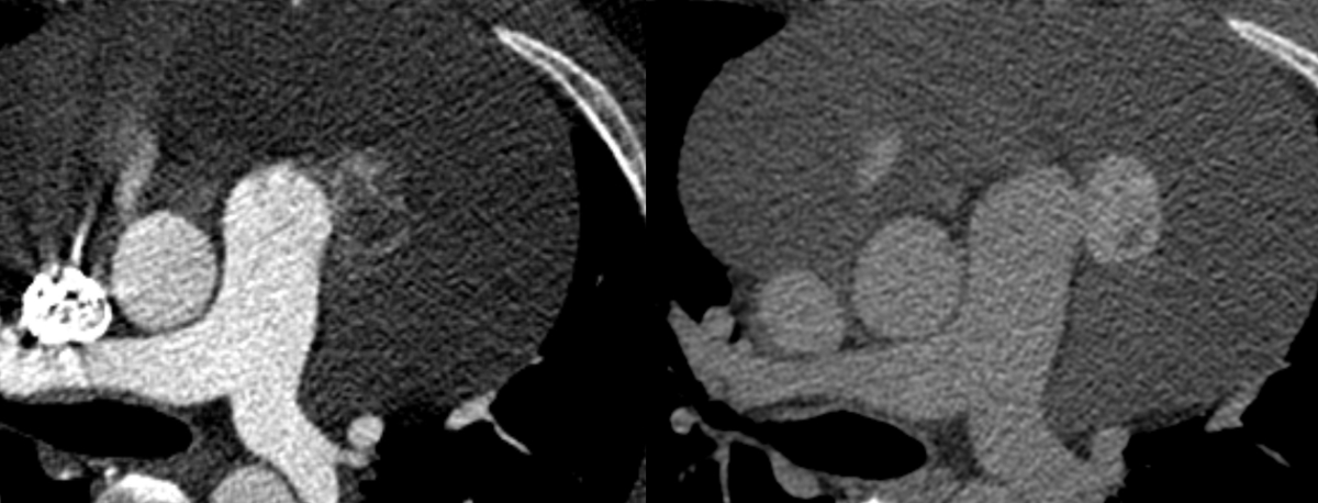 Cardiac mass