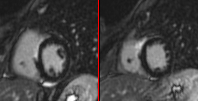 Cardiac Sarcoid