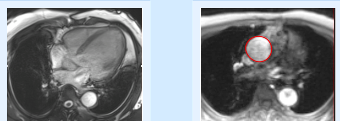 VHD Series: Mitral valve prolapse