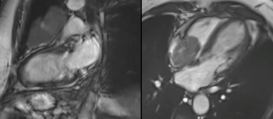 Cardiac Mass