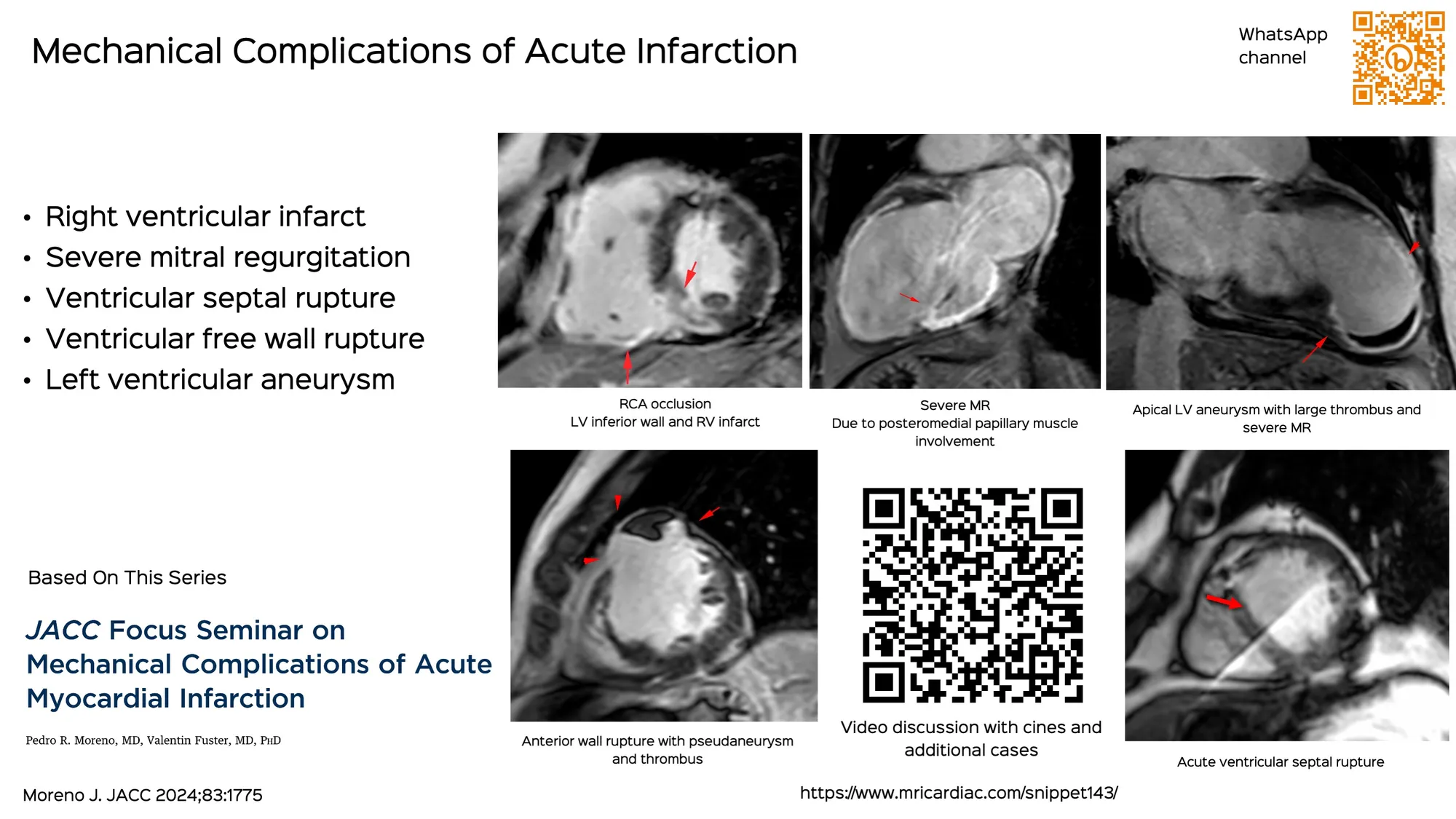 apical-hcm-revisited