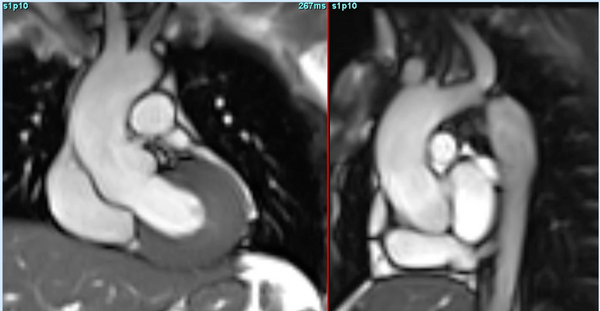 Coarctation of aorta