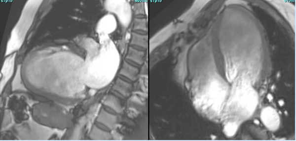 CMR in valvular HD