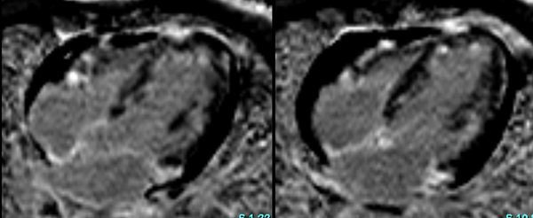 Eosonophilic myocarditis