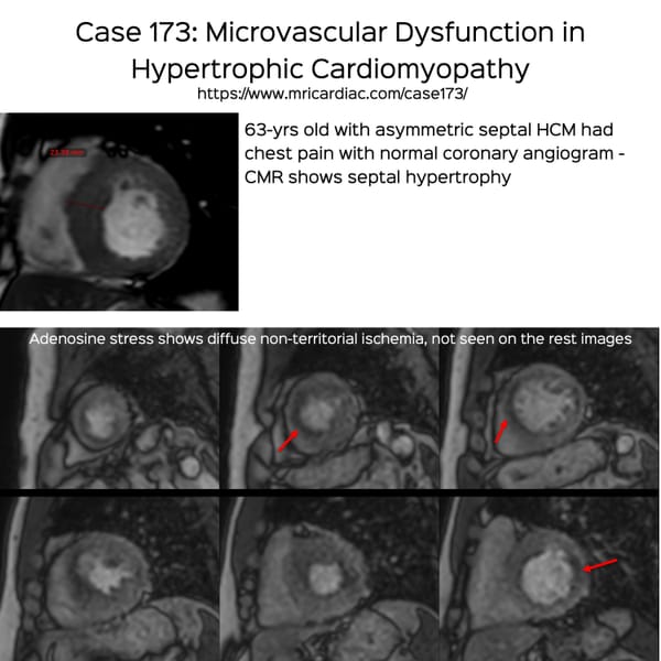 Case 173: Microvascular Dysfunction in Hypertrophic Cardiomyopathy