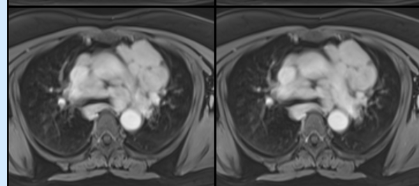 Pulmonary sarcoidosis