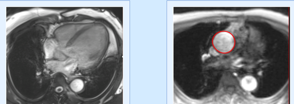 VHD Series: Secondary MR