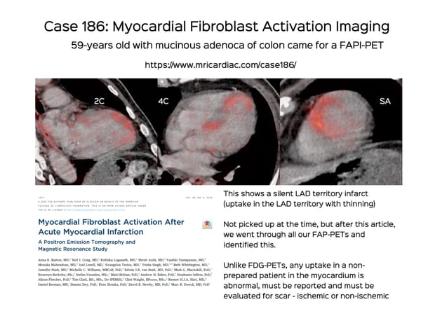 Case 186: Myocardial Fibroblast Activation Imaging