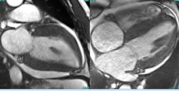 CMR for LV hypertrophy